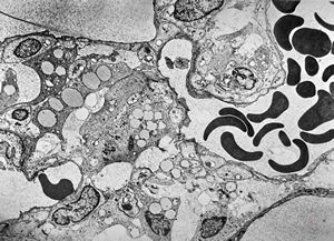 F,49y. | hemangioblastoma - brain F,49y. | hemangioblastoma - brain